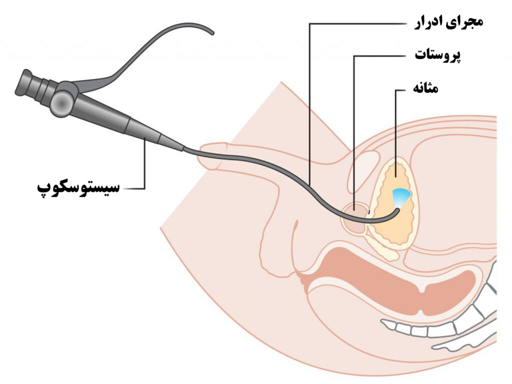 عمل تنگی مجرای ادرار با سیستوسکوپ
